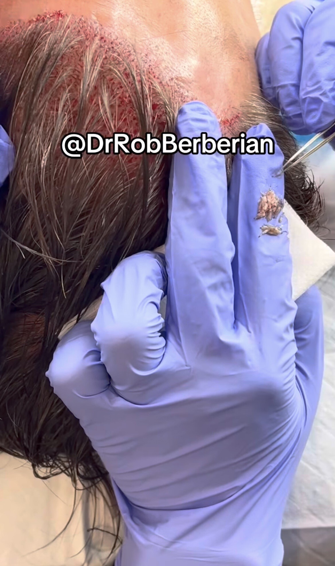 Dr. Rob Berberian VIP FUE Hair Transplant Newport Beach & Los Angeles California Dr. Rob Berberian VIP FUE Hair Transplant Newport Beach & Los Angeles California