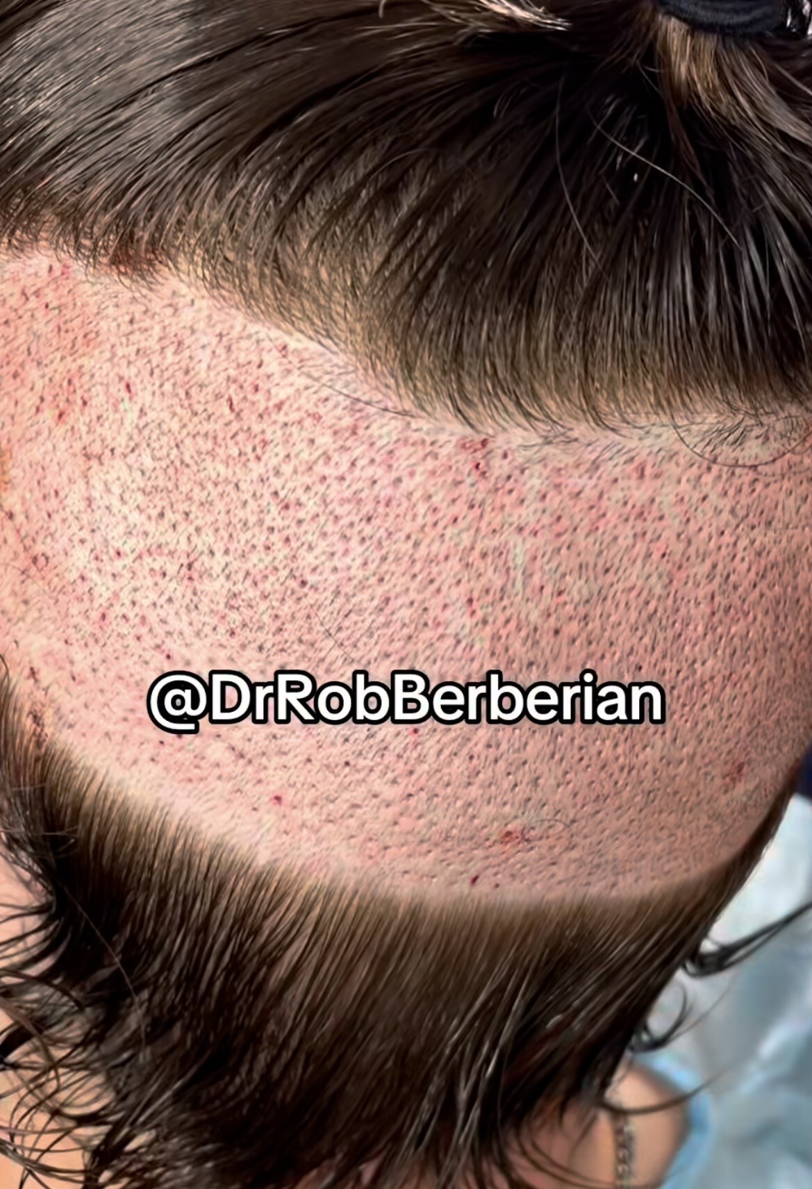 Dr. Rob Berberian VIP FUE Hair Transplant Newport Beach & Los Angeles California Dr. Rob Berberian VIP FUE Hair Transplant Newport Beach & Los Angeles California
