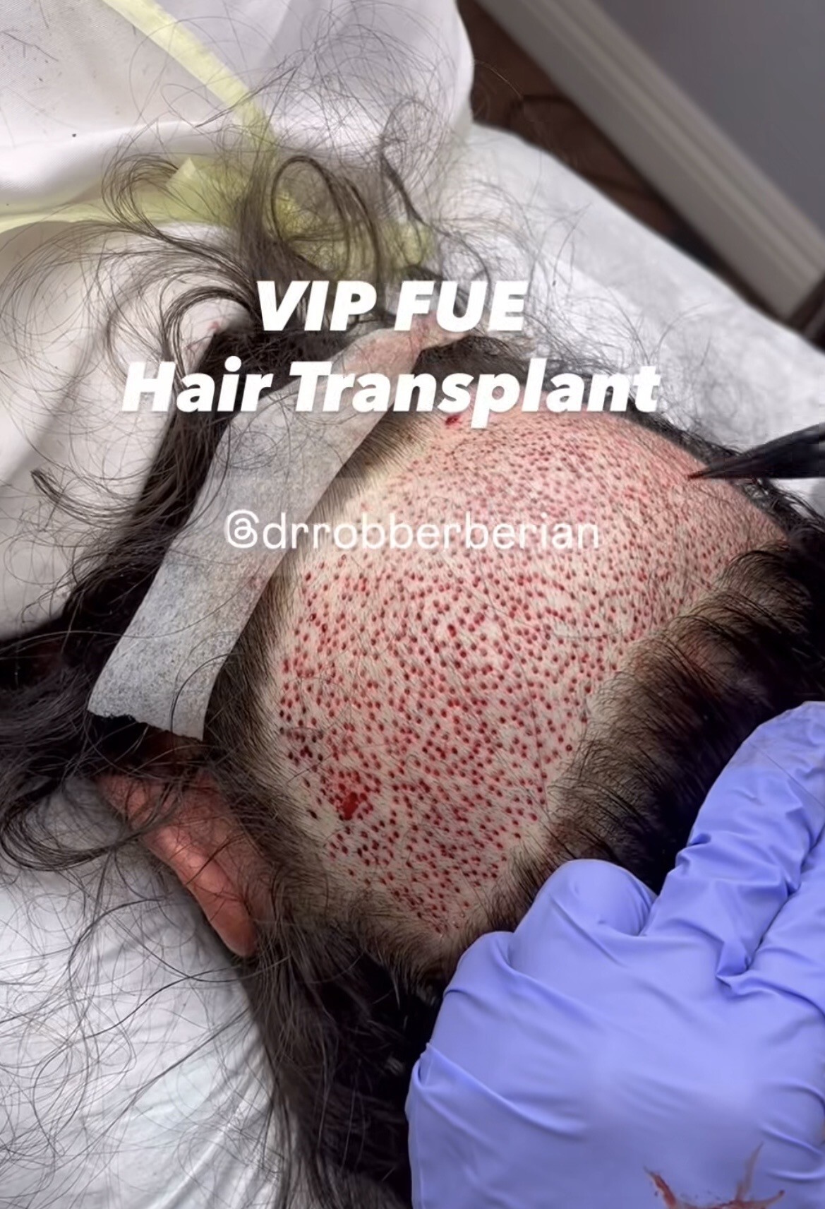 Dr. Rob Berberian VIP FUE Hair Transplant Newport Beach & Los Angeles California Dr. Rob Berberian VIP FUE Hair Transplant Newport Beach & Los Angeles California