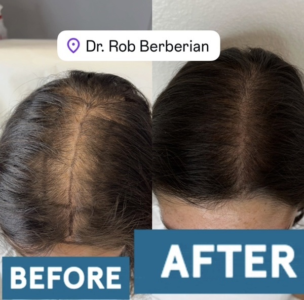 Female Hair Transplant Dr. Rob Berberian Before After Los Angeles & Newport Beach California Female Hair Transplant Dr. Rob Berberian Before After Los Angeles & Newport Beach California